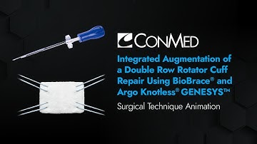 Augmentation of Double Row RCR using BioBrace® and Argo Knotless® GENESYS™ - CONMED Animation