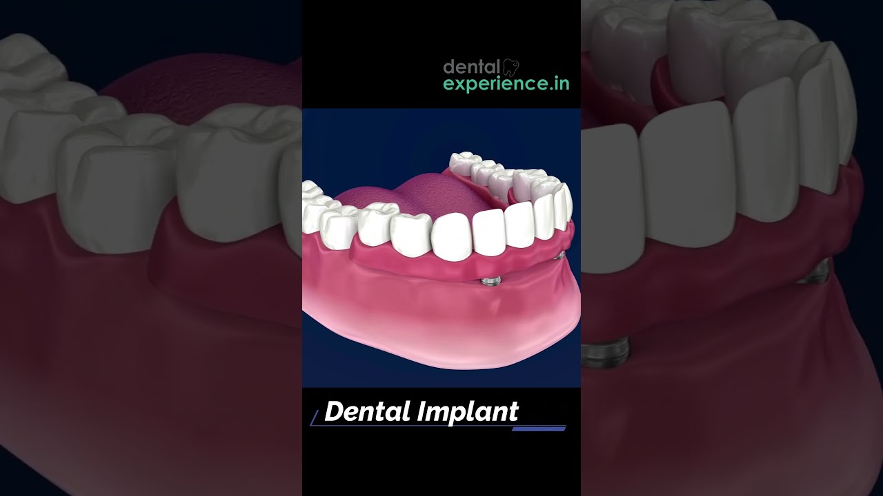 Affordable Full Mouth Dental Implants Cost for Replacing Missing Teeth.