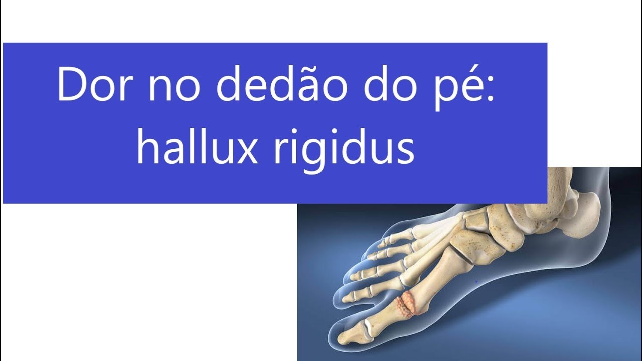 O dedão que dói: hallux rigidus e artrose no pé