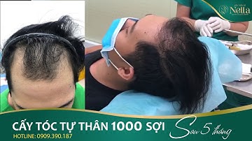CẤY TÓC TỰ THÂN 1000 NANG SAU 5 THÁNG TẠI NELLA