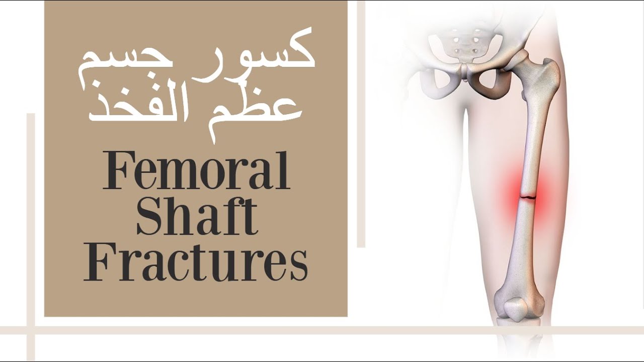переломы бедренной кости - с субтитрами