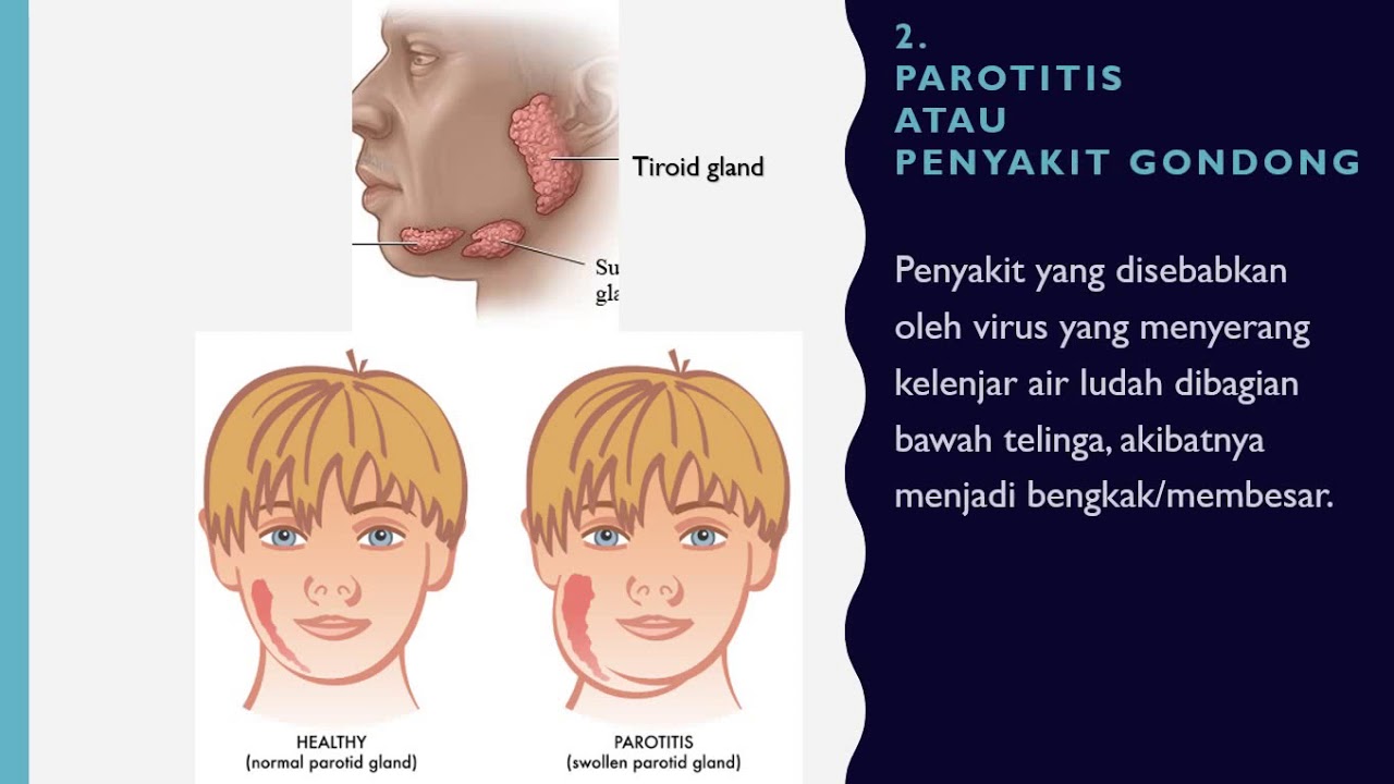 Parotitis adalah gangguan sistem pencernaan yang disebabkan ….