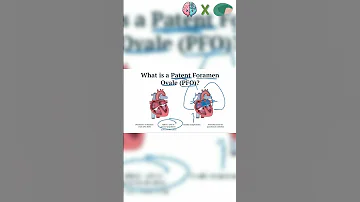 What Is A Patent Foramen Ovale PFO Chronicillness Science Occipitalneuralgia Migraine Step1 