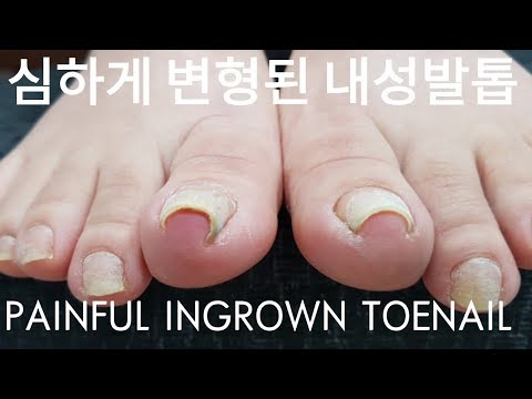 [시원함주의!!]😣심하게 변형된 내성발톱 교정영상!!😢PAINFUL INGROWN TOENAIL!!😄왕건이는 덤!!