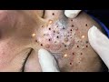 Removing Blackheads تلميع و تنظيف الرؤوس السوداء من الوجه