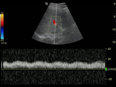 Portal Vein Doppler - Normal Monophasic Flow