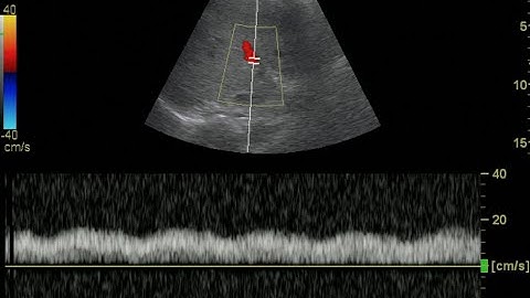 Portal Vein Doppler - Normal Monophasic Flow