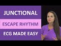 Junctional Escape Rhythm Quiz