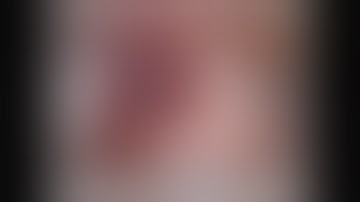 Extralobar pulmonary sequestration