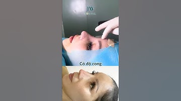 Bác sĩ Tú Dung NÂNG MŨI S LINE cứu Việt kiều Mỹ 9X khỏi mũi cao Tây BÓNG ĐỎ