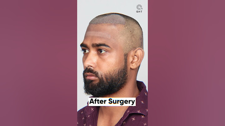 Six Months Hair Transplant Results | Latest Fue Technique #shorts #viral #hair transplant