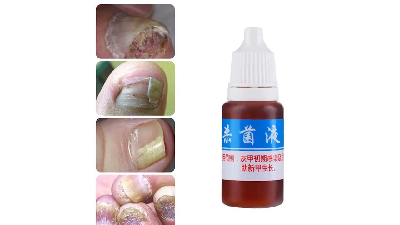 Китайский Сайт Купить От Грибка Ногтей Алиэкспресс - YouTube