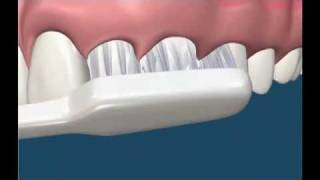 Tooth Brushing Technique - Dental hygiene in Sydney Castle Hill Australia call 02  9659 1200