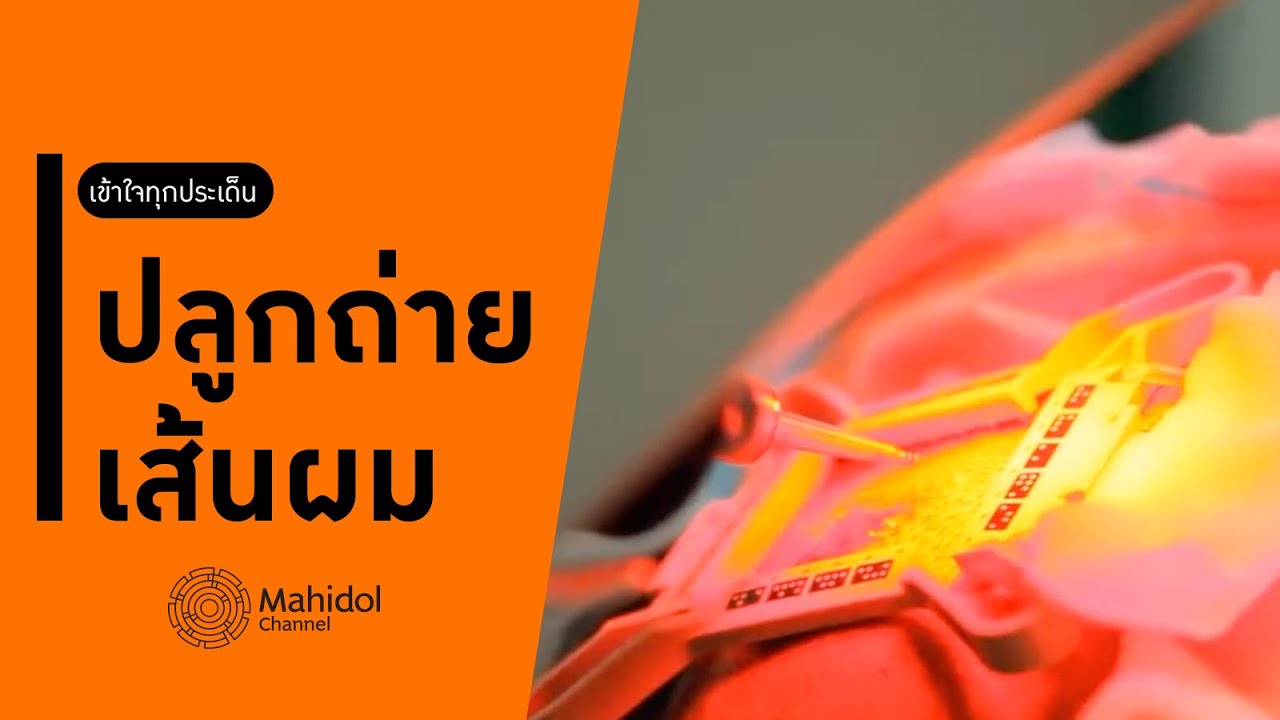 เบื้องหลังผ่าตัด "ปลูกถ่ายเส้นผม" แก้ปัญหาผมบาง ศีรษะล้าน [หาหมอ by Mahidol Channel]