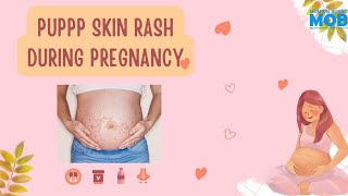 PUPPP Skin Rash During Pregnancy | SMOB