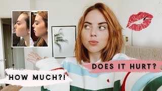 MY LIP + CHIN FILLER EXPERIENCE!