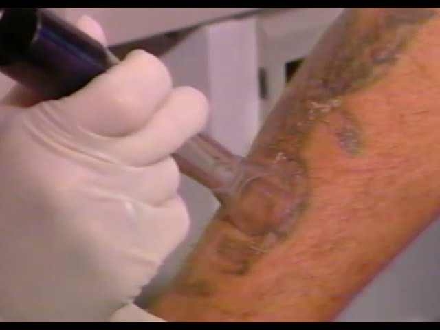 The Best Tattoo Removal Laser for Your Business  Laser Resellers