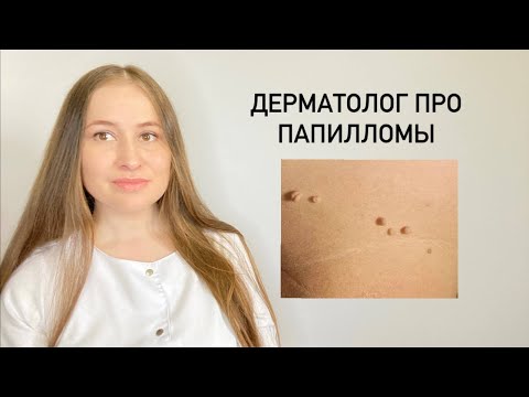 Как безопасно удалить папилломы на теле?