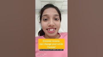 Transform your Smile with CAD CAM Zirconia crowns; Dr. Srishti Bhatia #dentist