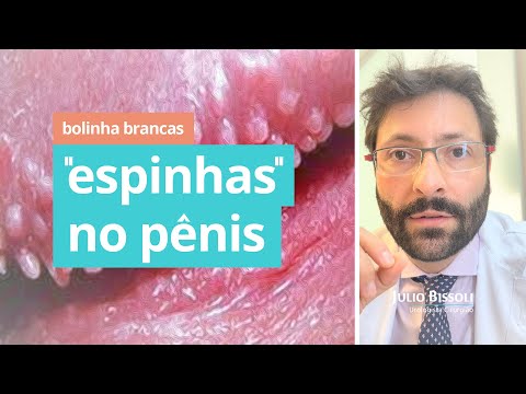 Bolinhas Brancas no Pênis parecidas com Espinhas