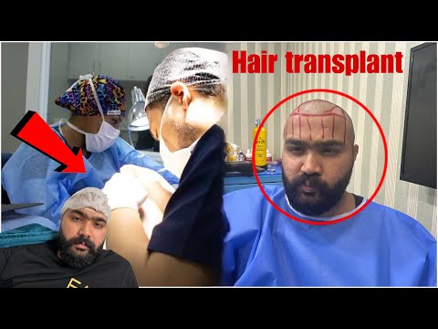 Hair Transplant Too Much Pain 😥😰😭  How’s  The Experience 😡