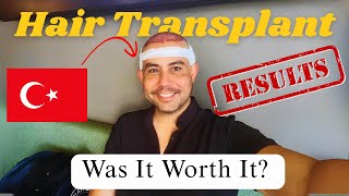 What You MUST Know Before Booking a Hair Transplant in Turkey