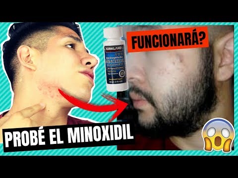 Lo que nadie te había dicho del MINOXIDIL | ¿Me creció la barba? (Mi experiencia)