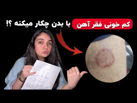۱۵ نشانه کم خونی فقر آهن در بدن که میتوانی تشخیص دهی دکتر بشری ویسی پزشک شما توضیح میدهد