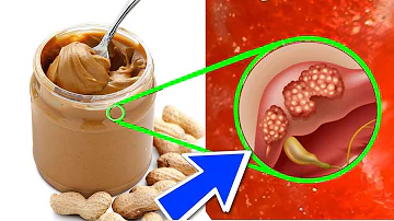 ¿Es cancerígena la mantequilla de cacahuete?