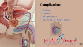 Vasectomy Complications