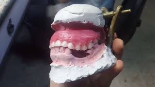 59 28072022 PROTESIS DENTAL TOTAL SUPERIOR DEFORME