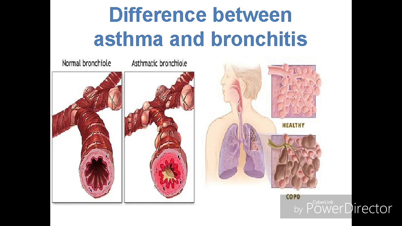 asthma and bronchitis image