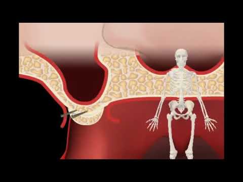 Alveolarna atrofija