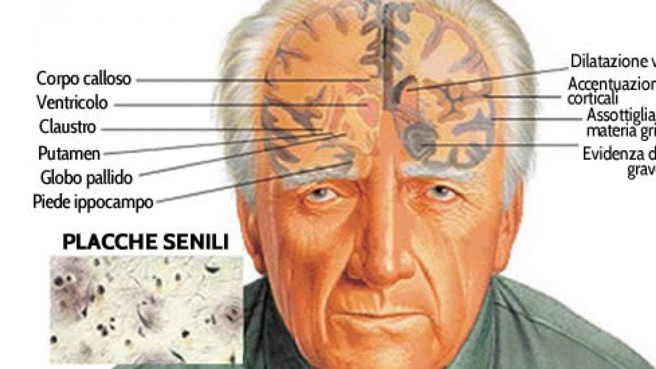 Alzheimer E Demenza Senile Sono La Stessa Cosa