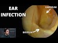 Ear infections and the problem of biofilm otitis externa