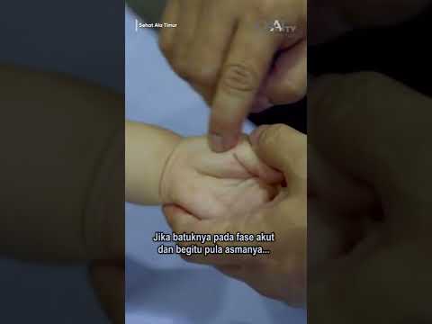 Video: Cara Merawat Asma: 15 Langkah (dengan Gambar)