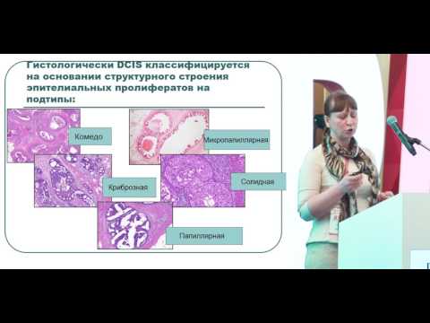 Video: Molekularni Pokretači Lobularnog Karcinoma In Situ