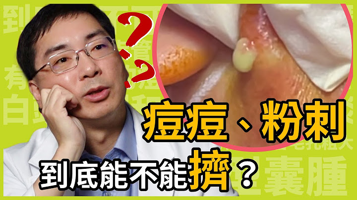 粉刺、痘痘到底能不能擠？如果不能擠應該怎麼處理才不會留疤？皮膚科林政賢醫師教你這樣擠痘才正確！ - 天天要聞