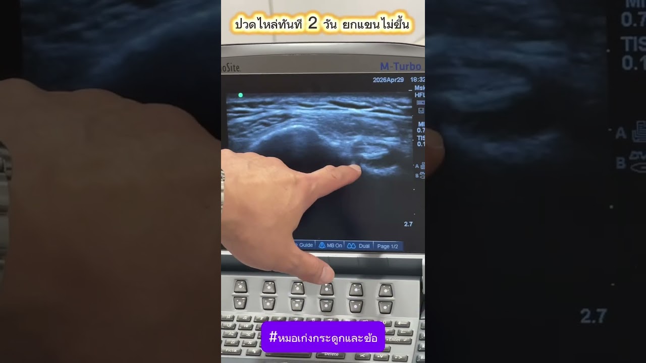 ปวดไหล่ทันที 2 วัน ยกแขนไม่ขึ้น
