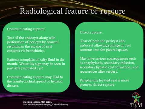 Video: Echinococcosis Of The Lungs - Causes, Symptoms And Diagnosis Of Echinococcosis Of The Lungs