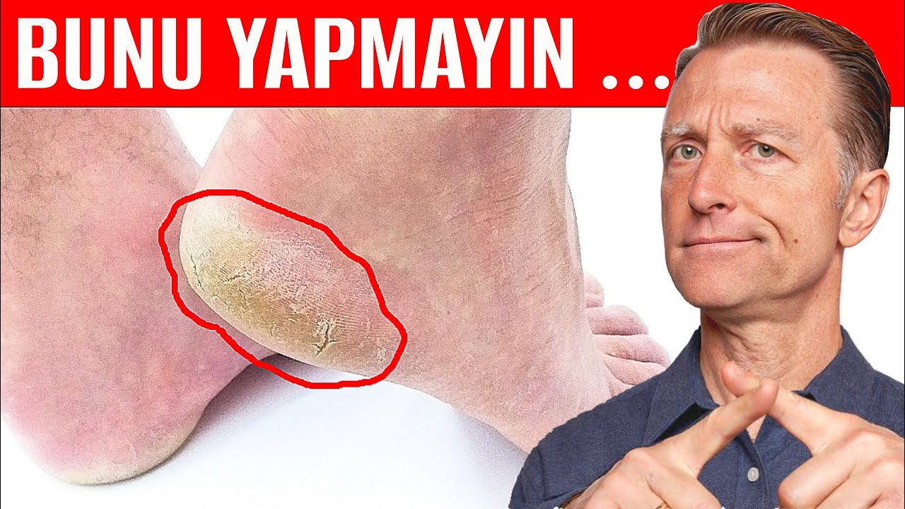 Çatlak Topuklar ve Kuru Ayaklar İçin Losyon Neden İşe Yaramaz? | Dr. Berg Türkçe
