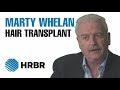 Marty whelan hair transplant testimonial  hrbr  hair restoration blackrock