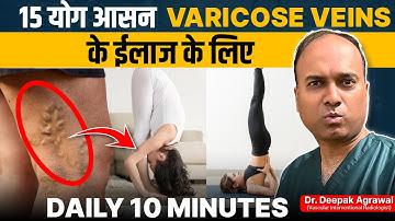 Yoga For Varicose Veins Diseases | 15 Asanas That Cures Varicose Veins Problem