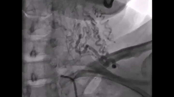 Subclavian steal syndrome