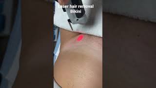 Laser hair removal on the bikini area of a female at ExcelLase