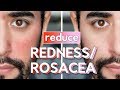 Red Skin & Rosacea On Face - Skin Care Routine, Hacks & Fixes ✖ James Welsh