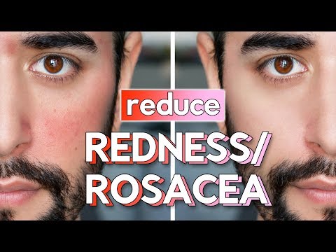 Red Skin & Rosacea On Face - Skin Care Routine, Hacks & Fixes ✖ James Welsh