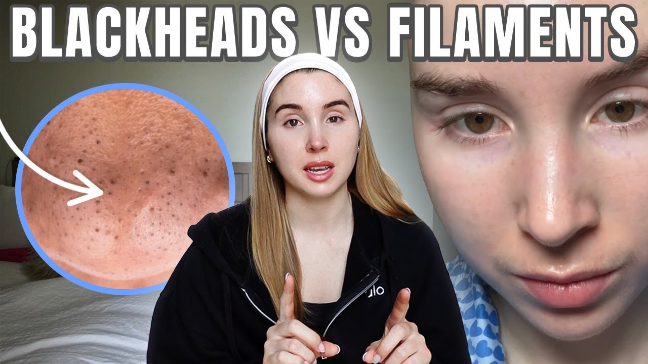 What's causing the SEBACEOUS FILAMENTS on your nose