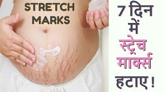7 दिन में Stretch Marks को ख़त्म कर Baby Soft त्वचा पाने का अचूक उपाय- Stretch Marks removal at home