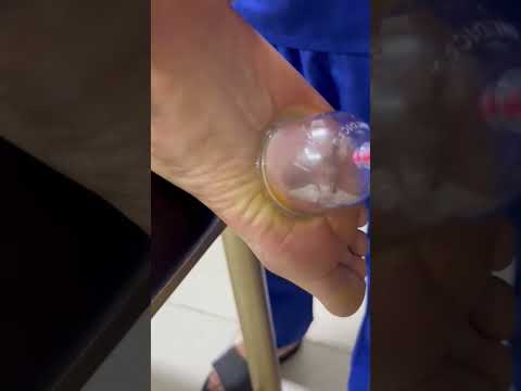 فيديو: التحكم في تعفن قدم الشعير - كيفية معالجة تعفن الشعير بالقدم